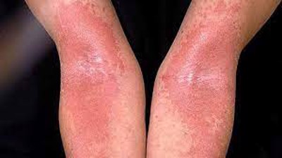 7 loại bệnh eczema – Triệu chứng, cách phòng ngừa và điều trị